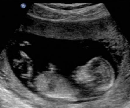 babyultrasound